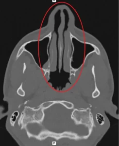 CT scan showing a deviated nasal septum